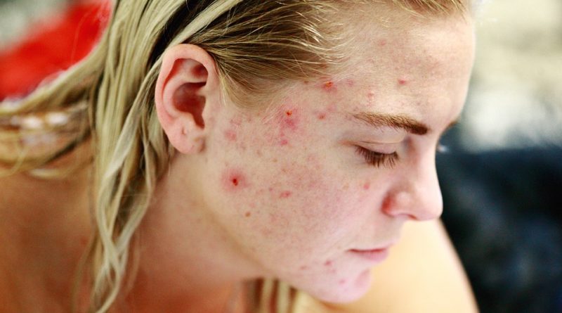 Seznamte se s dermatologickým onemocněním zvaným růžovka